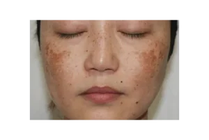 Nám hỗn hợp